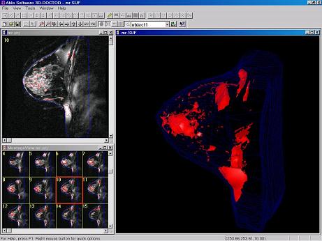 MRI breast imaging