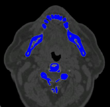 Dental CT segmentation