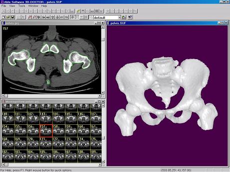 CT Pelvis 